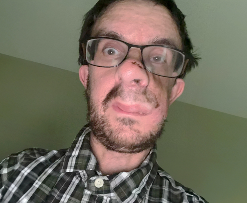 Eric V. After Facial Reconstructive Surgery.