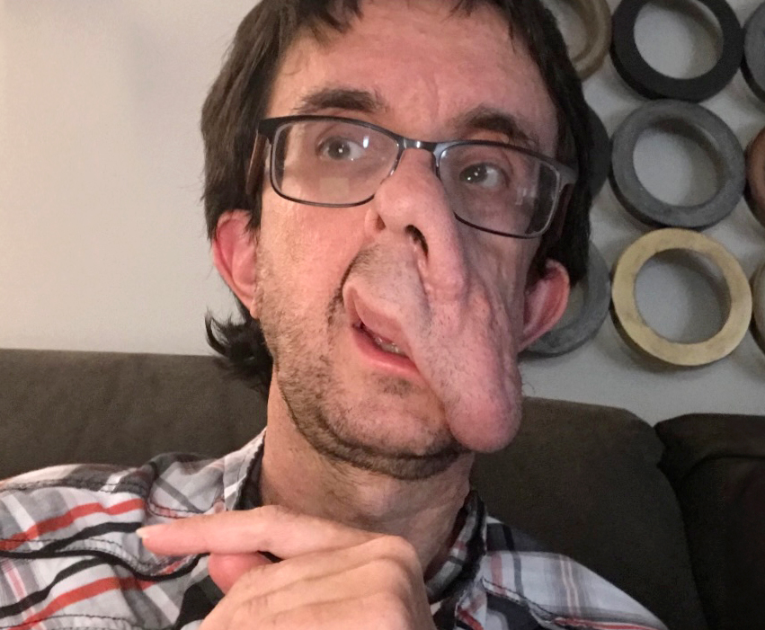 Eric V. Before Facial Reconstructive Surgery.